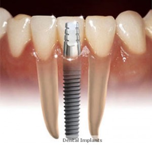 dental-implants