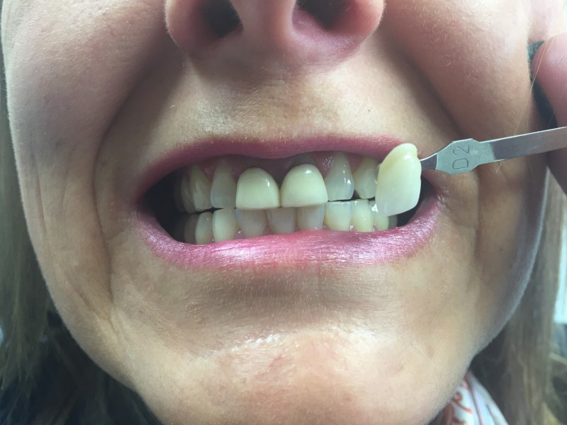 Gallery Dentist Bridgend Cosmetic Dentist South Wales